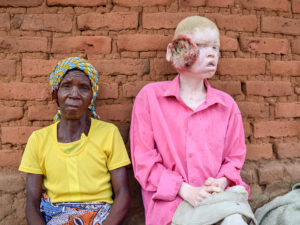Indigent Zimbabweans with Albinism-Related Skin Cancer Turned Away From Hospital